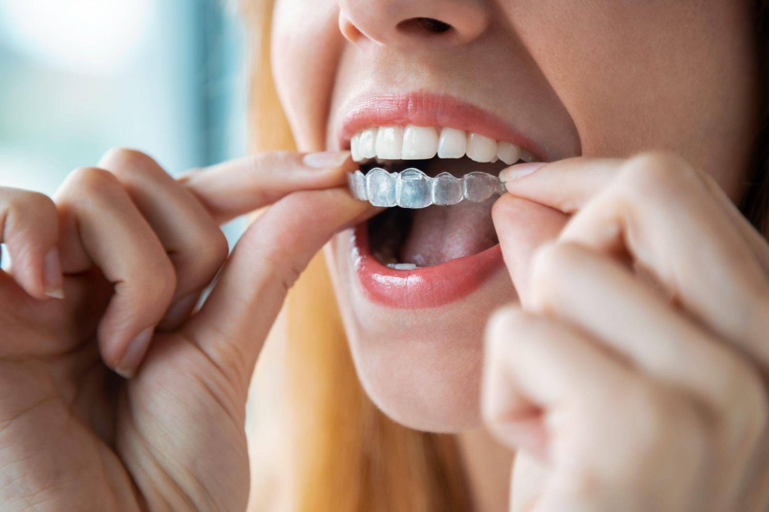 Clear Aligners in Hyderabad: The Best Invisible Braces for a Perfect Smile